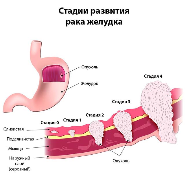 Рак желудка ▷ Лечение в Киеве - Диагностика и симптомы Рак желудка ▷ Лечение в Киеве - Диагностика и симптомы - фото 2