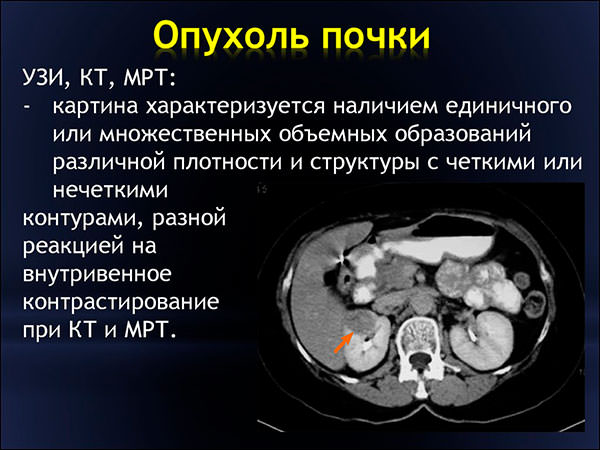 Виды диагностики рака почки Виды диагностики рака почки - фото 1