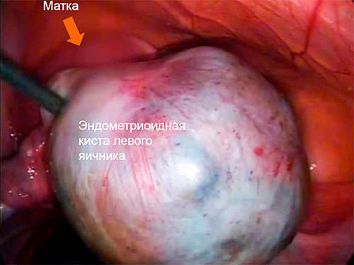 чем опасна эндометриоидная киста яичника. Смотреть фото чем опасна эндометриоидная киста яичника. Смотреть картинку чем опасна эндометриоидная киста яичника. Картинка про чем опасна эндометриоидная киста яичника. Фото чем опасна эндометриоидная киста яичника