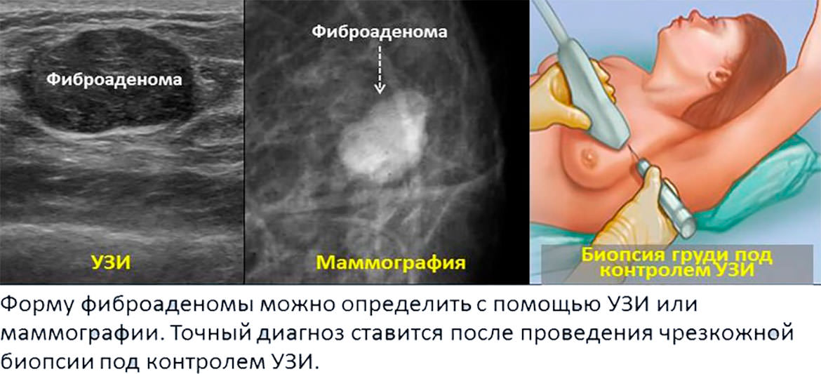 Фиброаденома молочной железы Фиброаденома молочной железы - фото 8