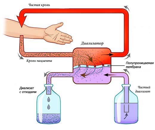 Фистула для гемодиализа картинки