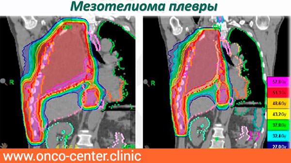 Мезотелиома плевры кт картина