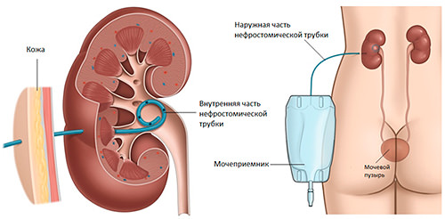 нефростомы в обеих почках что это. Смотреть фото нефростомы в обеих почках что это. Смотреть картинку нефростомы в обеих почках что это. Картинка про нефростомы в обеих почках что это. Фото нефростомы в обеих почках что это