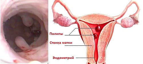 Полипы полости матки Полипы полости матки - фото 7