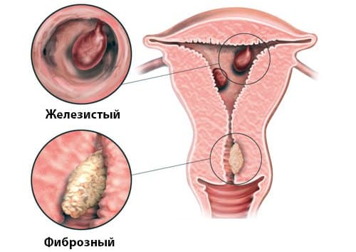 Полипы полости матки Полипы полости матки - фото 3