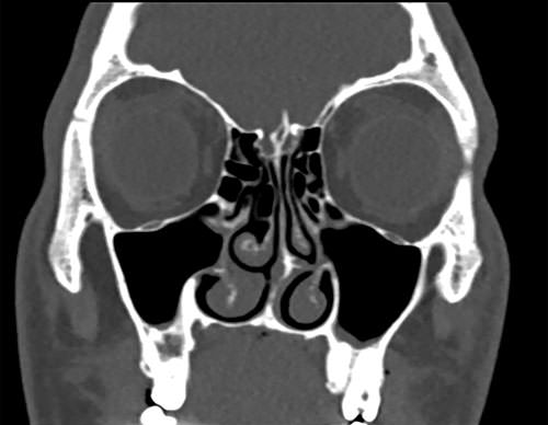 Кт околоносовых пазух фото