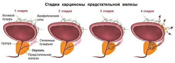 Рак простаты: причины, симптомы, диагностика, лечение рака простаты — Онкоцентр «Добрый прогноз» Рак простаты: причины, симптомы, диагностика, лечение рака простаты — Онкоцентр «Добрый прогноз» - фото 3