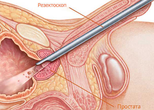 Mi a prostatitis és uretritis normal size of prostate gland in centimeters