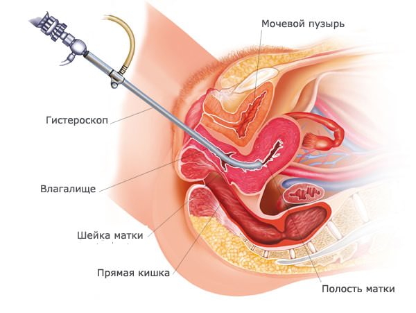 Гистероскопическая миомэктомия при субмукозной миоме матки Гистероскопическая миомэктомия при субмукозной миоме матки - фото 5