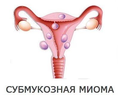 Гистероскопическая миомэктомия при субмукозной миоме матки Гистероскопическая миомэктомия при субмукозной миоме матки - фото 2