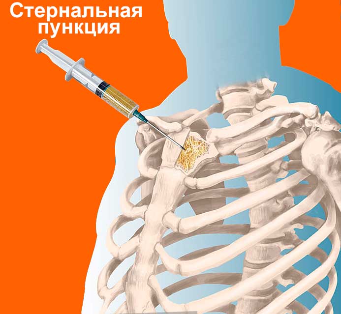 Стернальная пункция Стернальная пункция - фото 1