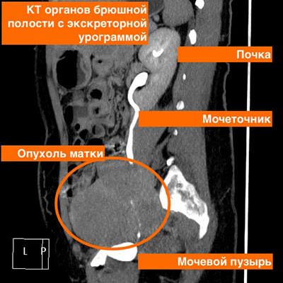 Картинка опухоль матки Опухоль матки фото