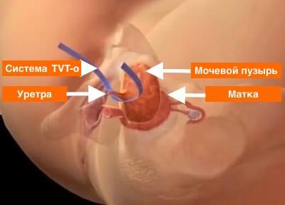 Вагинальная гистерэктомия