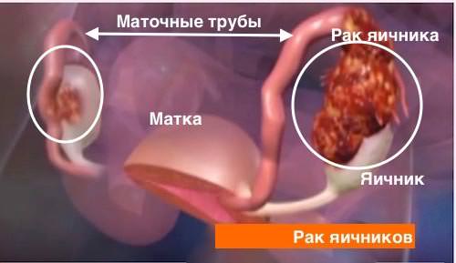 Картинка рак яичника Рак яичника
