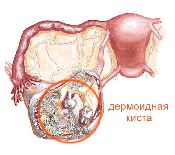 Виды кист яичника Виды кист яичника - фото 4
