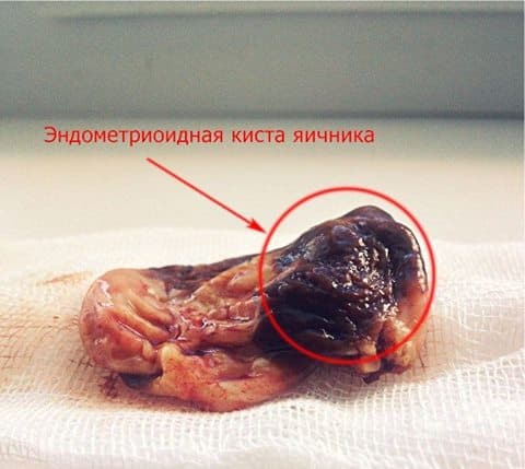 Виды кист яичника Виды кист яичника - фото 5
