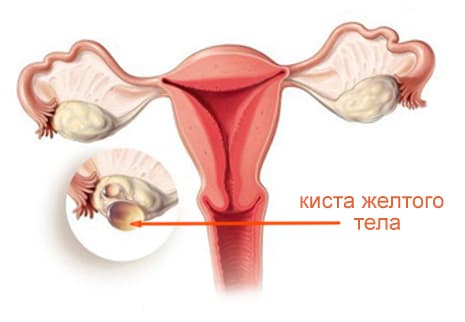 Виды кист яичника Виды кист яичника - фото 3