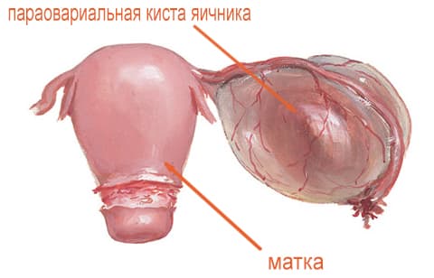 Виды кист яичника Виды кист яичника - фото 2
