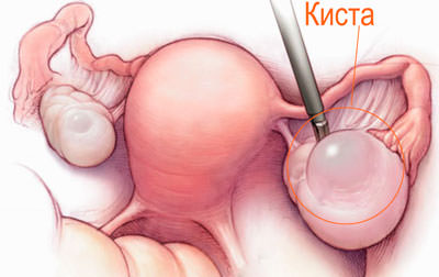 КИСТЫ ЯИЧНИКОВ ⁂ фолликулярная ▷ эндометриоидная ᐈ функциональная ▷ КИСТЫ ЯИЧНИКОВ ⁂ фолликулярная ▷ эндометриоидная ᐈ функциональная ▷ - фото 1