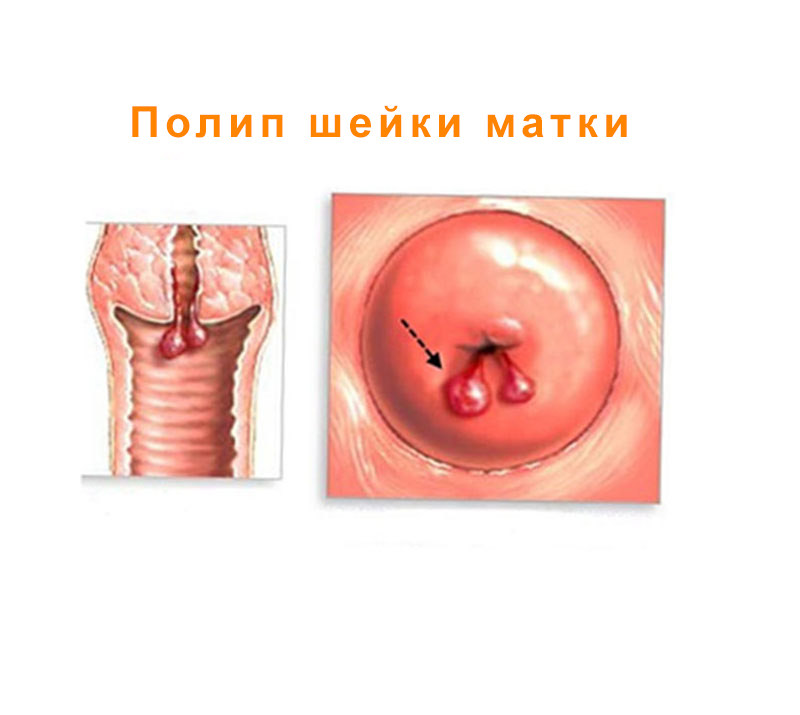 Полип шейки матки Полип шейки матки - фото 2
