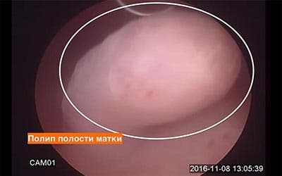 Полипы полости матки Полипы полости матки - фото 2