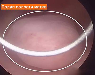 Полипы полости матки Полипы полости матки - фото 5