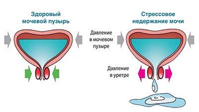Недержание мочи у женщин 2я статья Недержание мочи у женщин 2я статья - фото 2