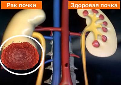 Картинка почка рак Рак почки фото