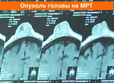 Фото МРТ опухоли головы Фото МРТ опухоли головы