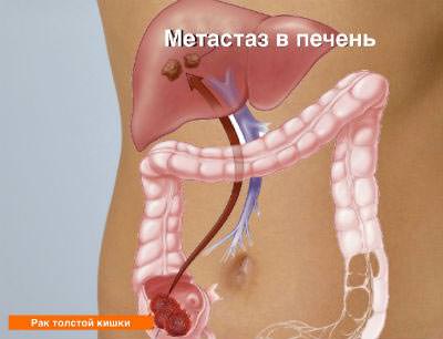 Картинка рак толстой кишки Рак толстой кишки