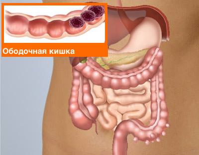 Картинка рак ободочной кишки Ободочная кишка