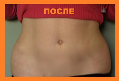 Картинка пластика ПОСЛЕ ДО и ПОСЛЕ