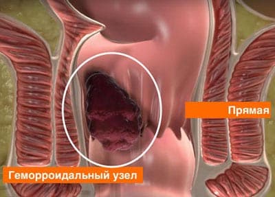 Латексное лигирование геморроидальных узлов Латексное лигирование геморроидальных узлов - фото 1