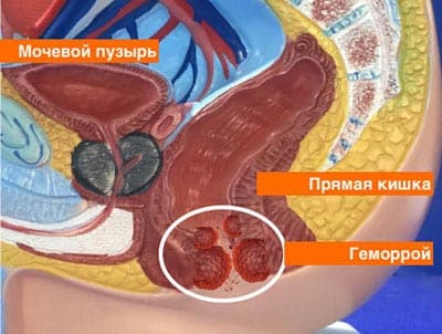 Картинка гемороя Геморрой фото лечение