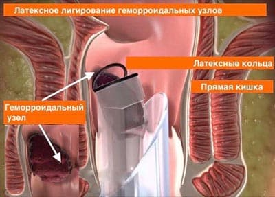 Картинка латексное легирование Латексное лигирование фото