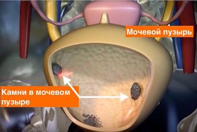 Картинка камни в пузыре мочевом Камни в мочевом пузыре