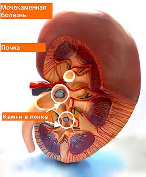 Картинка болезнь мочевая Мочекаменная болезнь