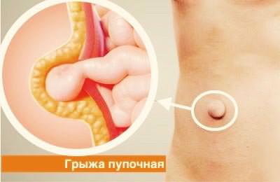 Хирургия грыж Хирургия грыж - фото 4