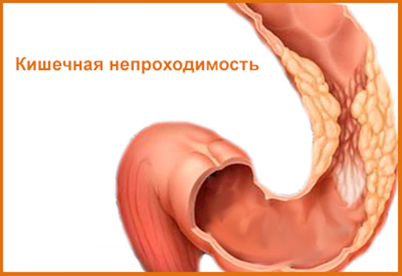 Kishechnaya Neprohodimost Prichiny Simptomy Diagnostika