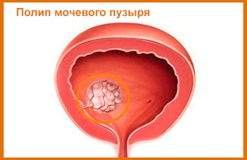 Симптомы мочевого пузыря у мужчин признаки. Полиповидное образование мочевого пузыря. Папиллома мочевого пузыря.