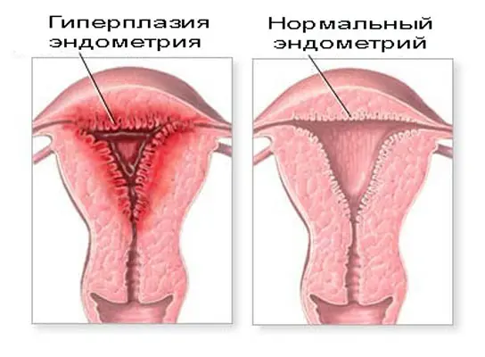 Гиперплазия эндометрия матки: симптомы, причины и методы лечения