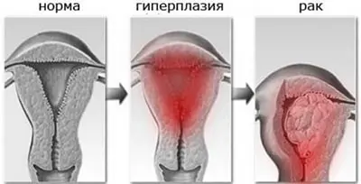 ≡ Гиперплазия эндометрия матки ᐈ Лечение гиперплазии в Киеве, цены
