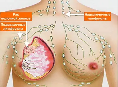 Рак молочной железы 1 стадия, прогноз и лечение рака груди (рмж) первой стадии